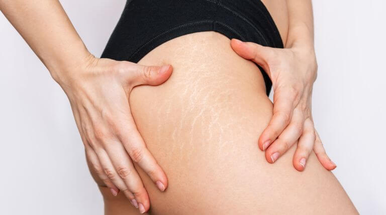 woman holding stretch marks on her leg